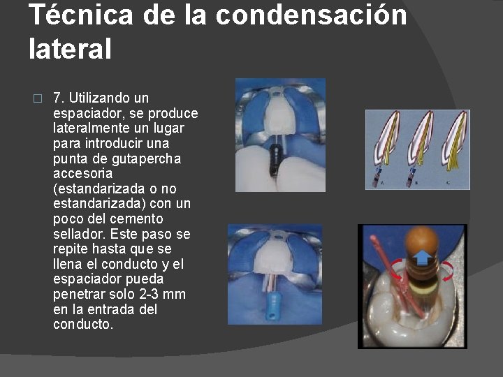 Técnica de la condensación lateral � 7. Utilizando un espaciador, se produce lateralmente un