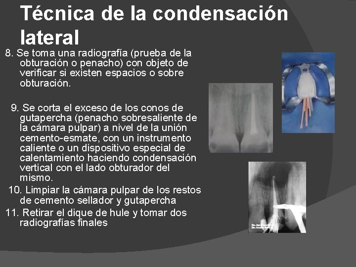 Técnica de la condensación lateral 8. Se toma una radiografía (prueba de la obturación