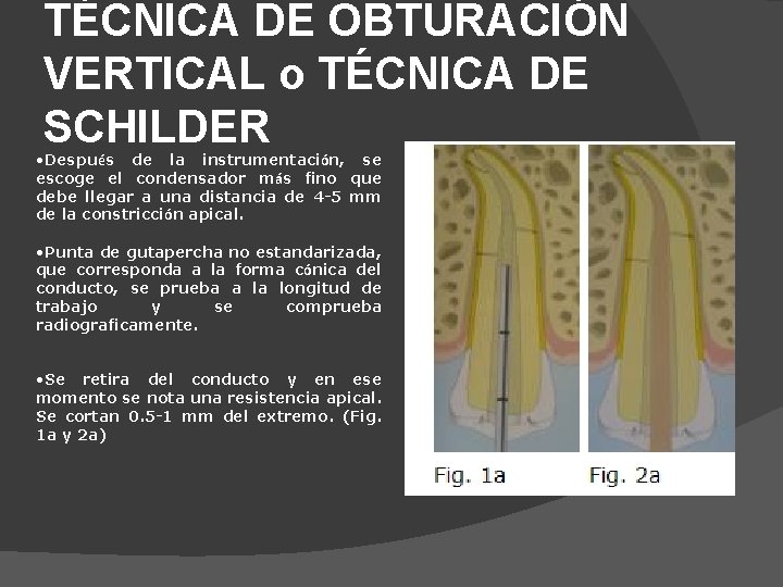 TÉCNICA DE OBTURACIÓN VERTICAL o TÉCNICA DE SCHILDER • Después de la instrumentación, se