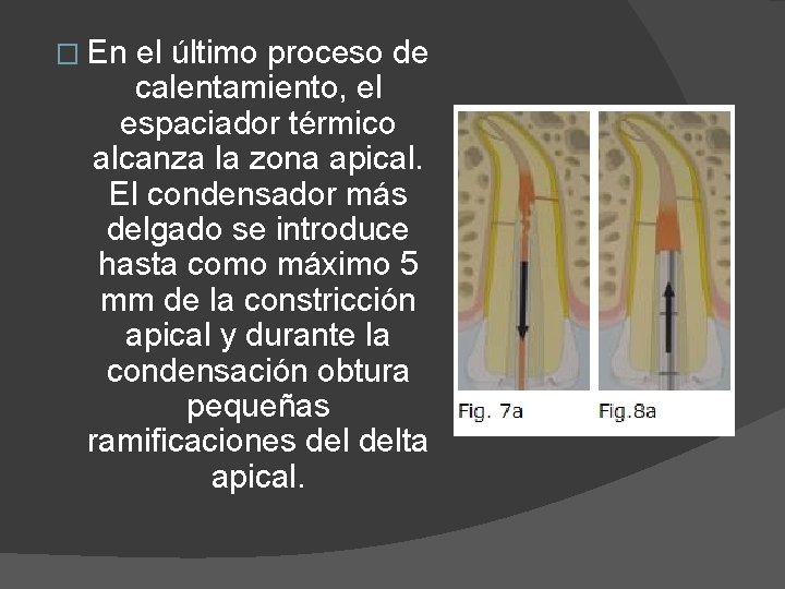 � En el último proceso de calentamiento, el espaciador térmico alcanza la zona apical.