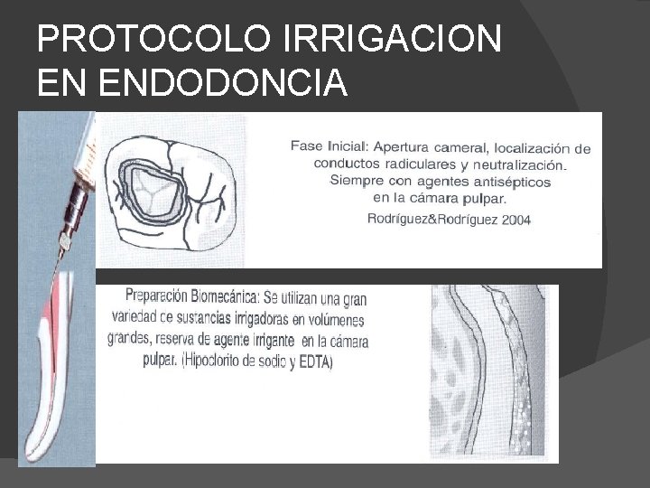 PROTOCOLO IRRIGACION EN ENDODONCIA 