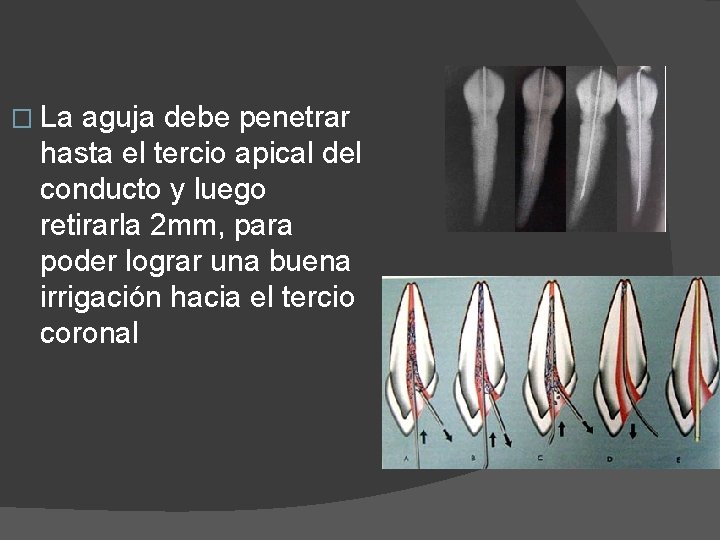 � La aguja debe penetrar hasta el tercio apical del conducto y luego retirarla