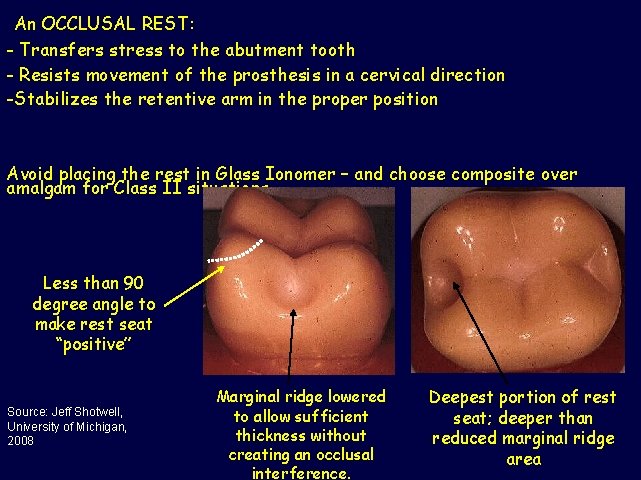 An OCCLUSAL REST: - Transfers stress to the abutment tooth - Resists movement of