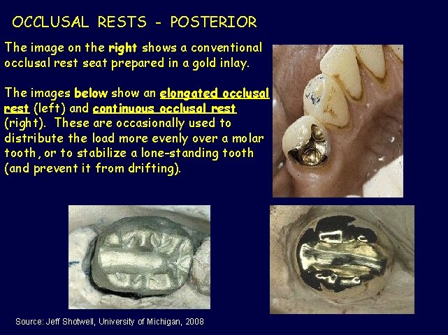 OCCLUSAL RESTS - POSTERIOR The image on the right shows a conventional occlusal rest