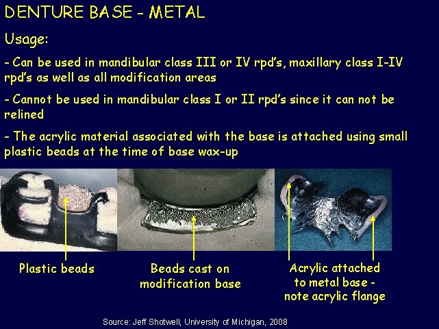 DENTURE BASE - METAL Usage: - Can be used in mandibular class III or