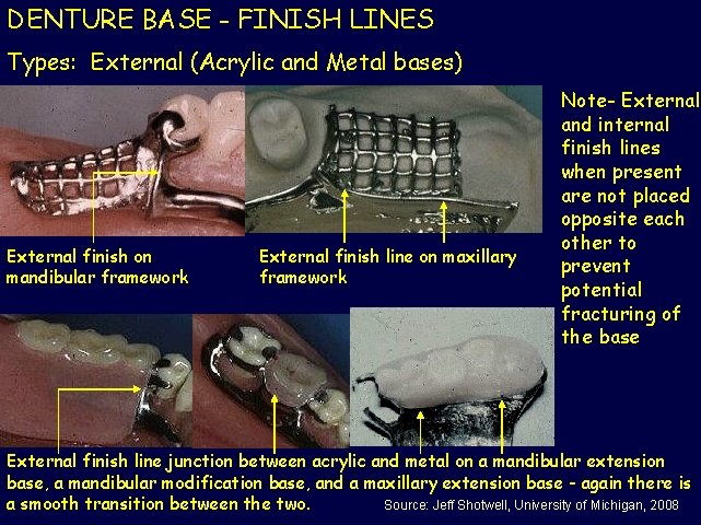DENTURE BASE - FINISH LINES Types: External (Acrylic and Metal bases) External finish on
