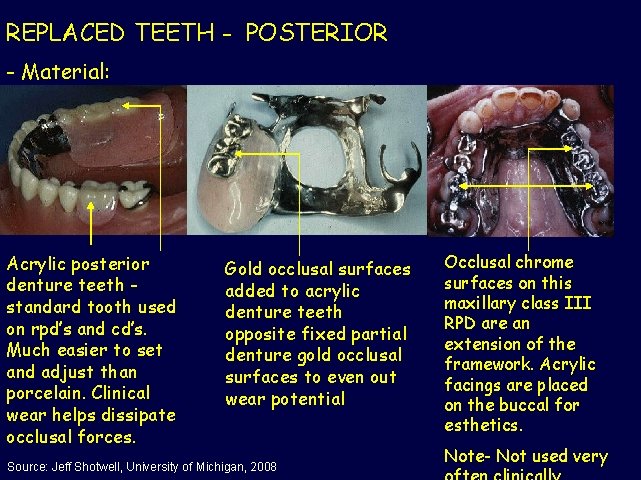 REPLACED TEETH - POSTERIOR - Material: Acrylic posterior denture teeth standard tooth used on