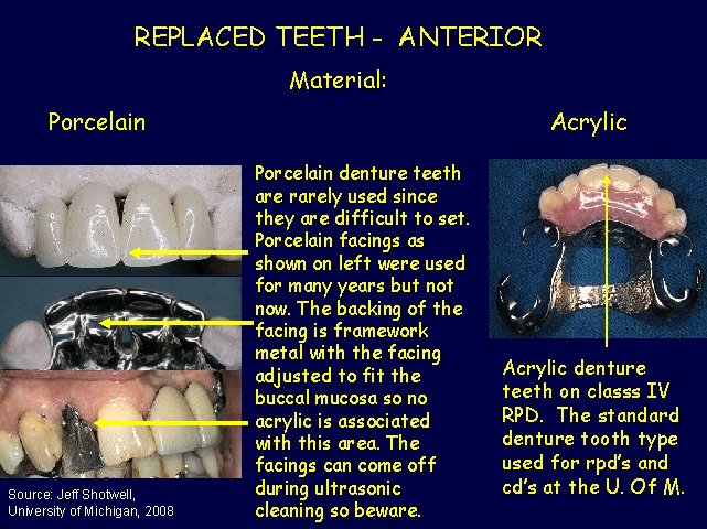 REPLACED TEETH - ANTERIOR Material: Porcelain Source: Jeff Shotwell, University of Michigan, 2008 Acrylic