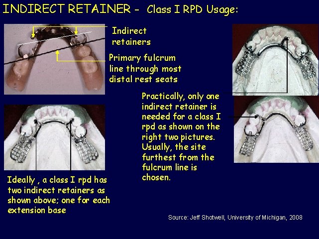 INDIRECT RETAINER - Class I RPD Usage: Indirect retainers Primary fulcrum line through most