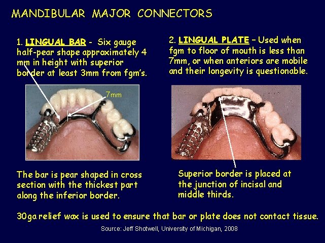 MANDIBULAR MAJOR CONNECTORS 1. LINGUAL BAR - Six gauge half-pear shape approximately 4 mm