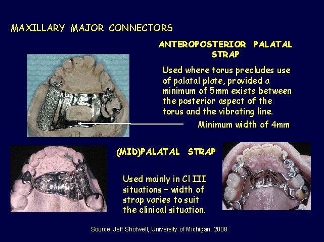 MAXILLARY MAJOR CONNECTORS ANTEROPOSTERIOR PALATAL STRAP Used where torus precludes use of palatal plate,