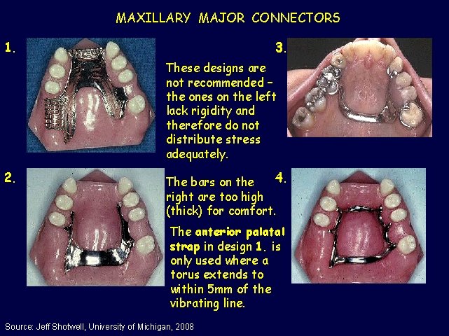 MAXILLARY MAJOR CONNECTORS 1. 3. These designs are not recommended – the ones on