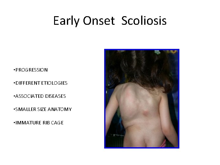 Early Onset Scoliosis • PROGRESSION • DIFFERENT ETIOLOGIES • ASSOCIATED DISEASES • SMALLER SIZE