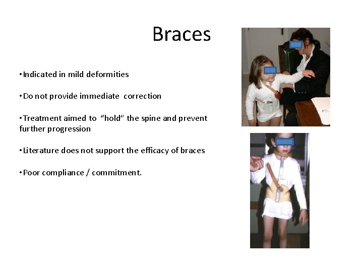 Braces • Indicated in mild deformities • Do not provide immediate correction • Treatment