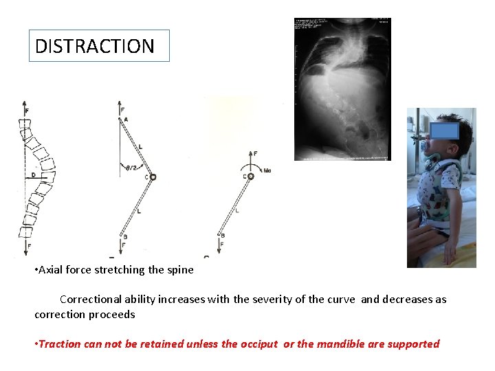 DISTRACTION • Axial force stretching the spine • The Correctional ability increases with the