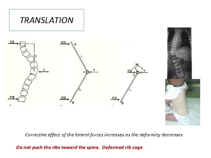 TRANSLATION The Corrective effect of the lateral forces increases as the deformity decreases Do