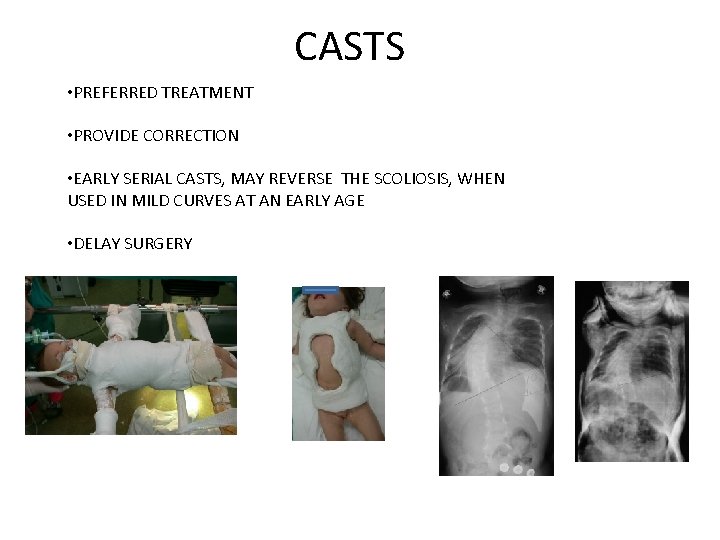 CASTS • PREFERRED TREATMENT • PROVIDE CORRECTION • EARLY SERIAL CASTS, MAY REVERSE THE