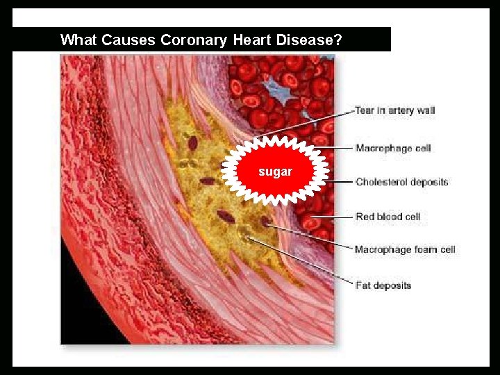 What Causes Coronary Heart Disease? Cross Section of a Damaged Artery sugar 