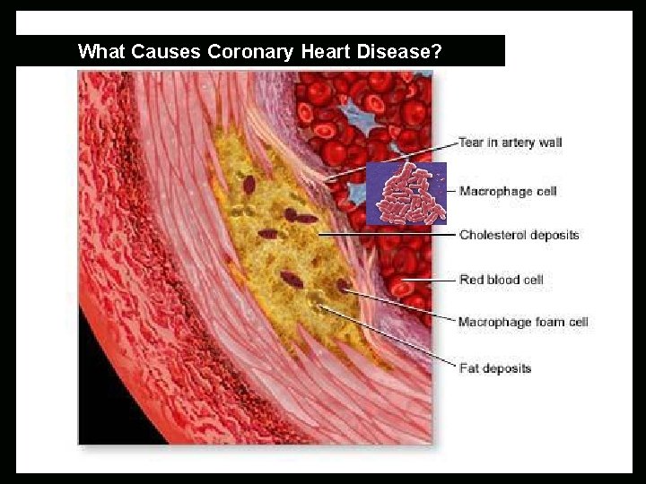 What Causes Coronary Heart Disease? 