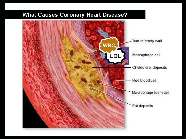 What Causes Coronary Heart Disease? WBC LDL 