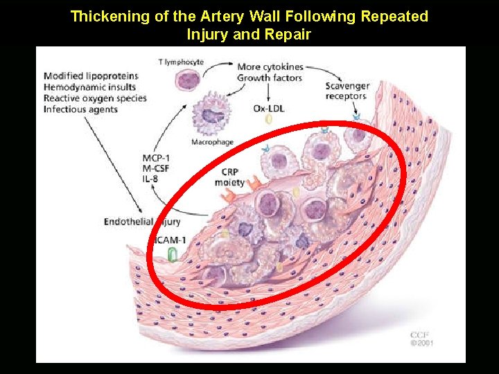 Thickening of the Artery Wall Following Repeated Injury and Repair 