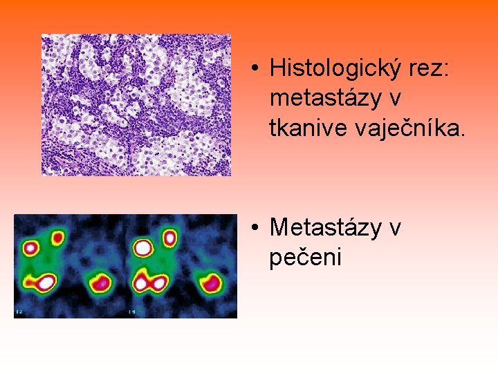  • Histologický rez: metastázy v tkanive vaječníka. • Metastázy v pečeni 