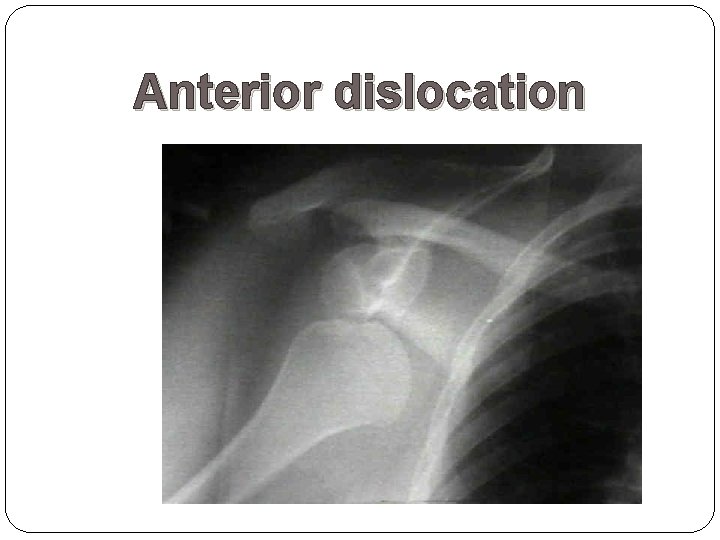 Anterior dislocation 