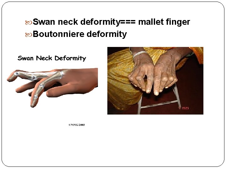  Swan neck deformity=== mallet finger Boutonniere deformity 