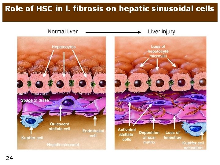 Role of HSC in l. fibrosis on hepatic sinusoidal cells 24 