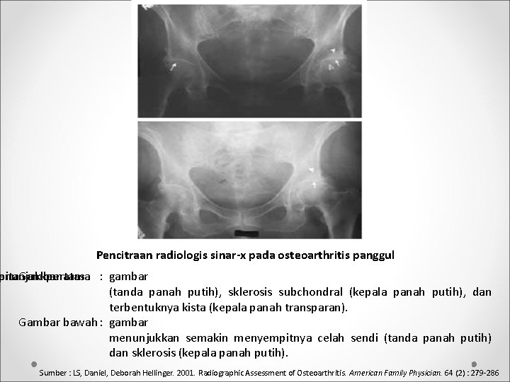 Pencitraan radiologis sinar-x pada osteoarthritis panggul enunjukkan pitan Gambar pertama atas : gambar (tanda