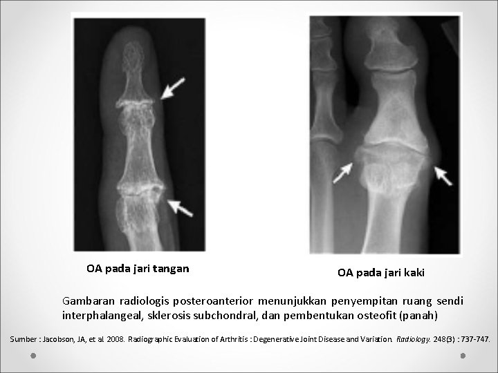 OA pada jari tangan OA pada jari kaki Gambaran radiologis posteroanterior menunjukkan penyempitan ruang