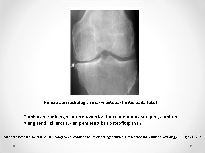 Pencitraan radiologis sinar-x osteoarthritis pada lutut Gambaran radiologis anteroposterior lutut menunjukkan penyempitan ruang sendi,