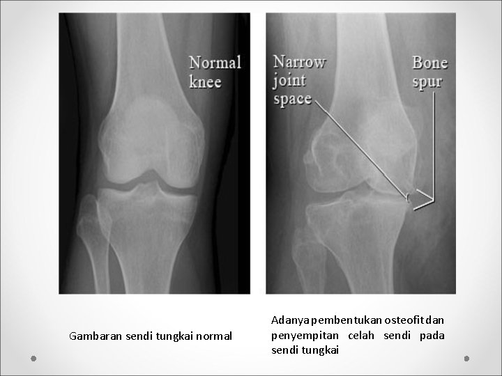 Gambaran sendi tungkai normal Adanya pembentukan osteofit dan penyempitan celah sendi pada sendi tungkai