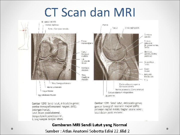 CT Scan dan MRI Gambaran MRI Sendi Lutut yang Normal Sumber : Atlas Anatomi