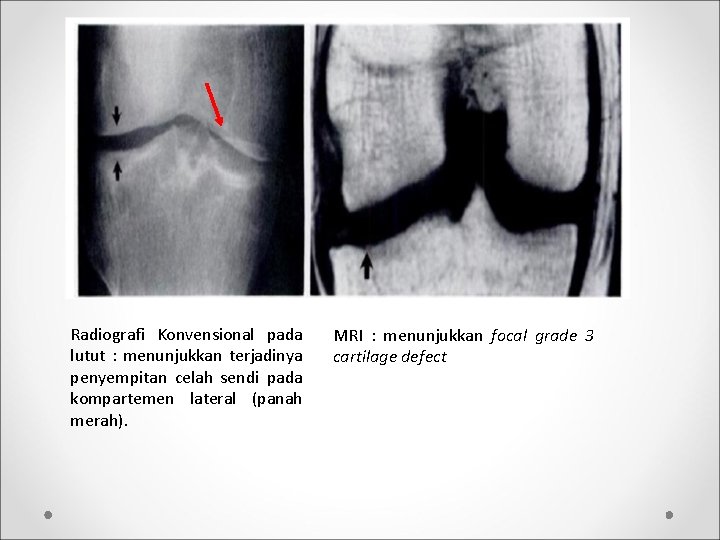 Radiografi Konvensional pada lutut : menunjukkan terjadinya penyempitan celah sendi pada kompartemen lateral (panah