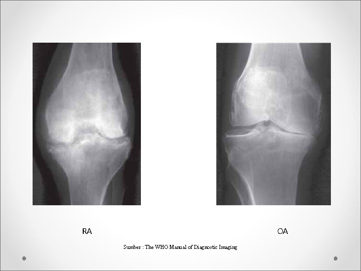 RA OA Sumber : The WHO Manual of Diagnostic Imaging 
