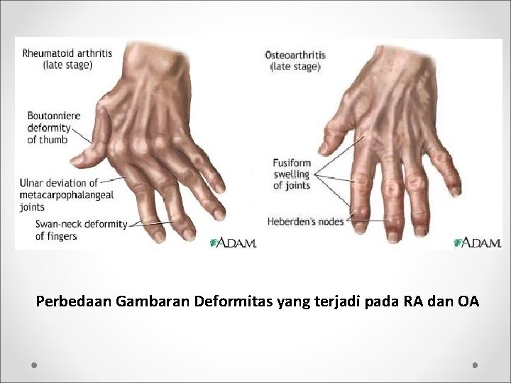 Perbedaan Gambaran Deformitas yang terjadi pada RA dan OA 