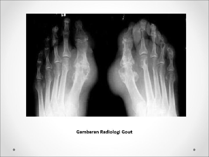 Gambaran Radiologi Gout 