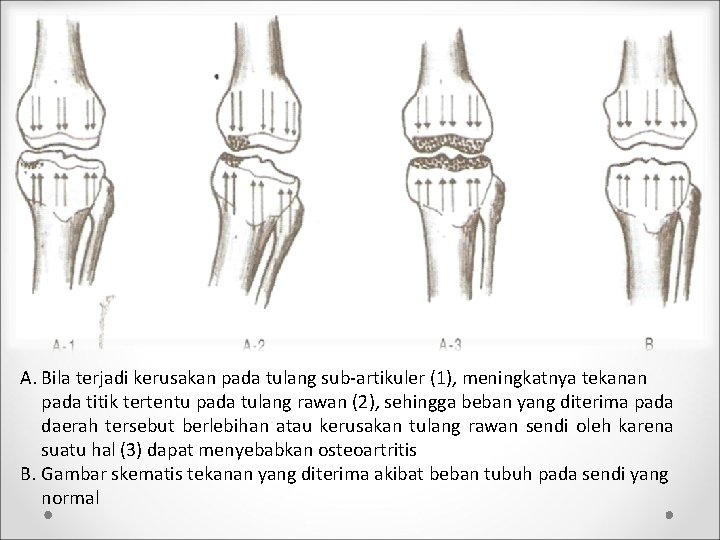A. Bila terjadi kerusakan pada tulang sub-artikuler (1), meningkatnya tekanan pada titik tertentu pada