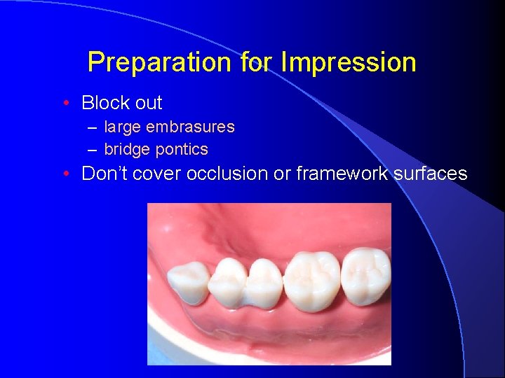 Preparation for Impression • Block out – large embrasures – bridge pontics • Don’t