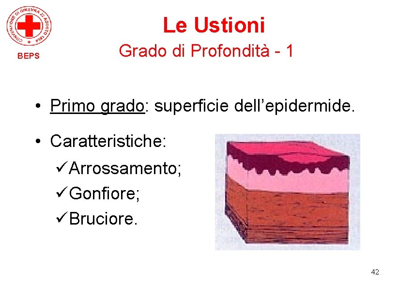 Le Ustioni BEPS Grado di Profondità - 1 • Primo grado: superficie dell’epidermide. •