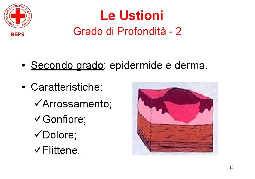 Le Ustioni BEPS Grado di Profondità - 2 • Secondo grado: epidermide e derma.