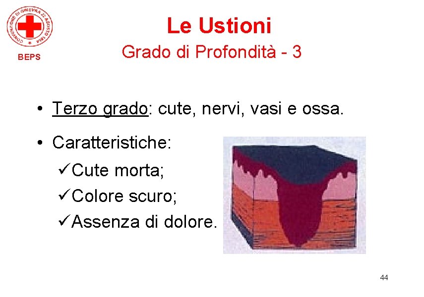 Le Ustioni BEPS Grado di Profondità - 3 • Terzo grado: cute, nervi, vasi