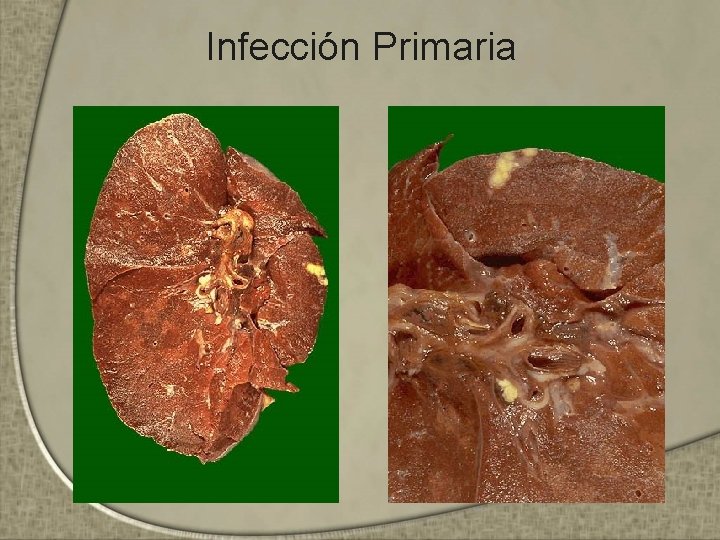 Infección Primaria 