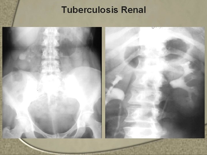 Tuberculosis Renal 