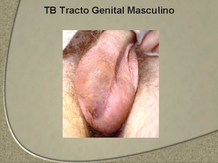 TB Tracto Genital Masculino 