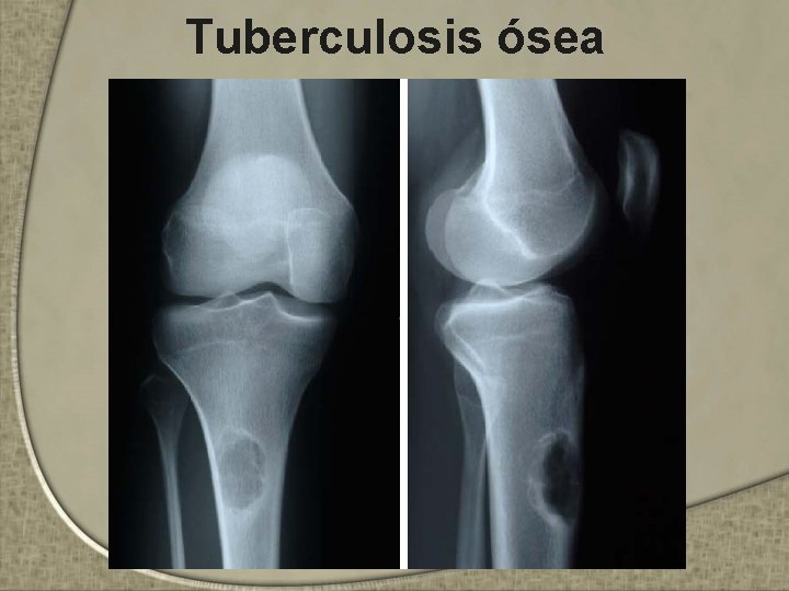 Tuberculosis ósea 