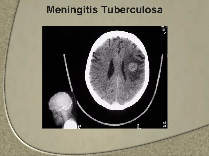 Meningitis Tuberculosa 