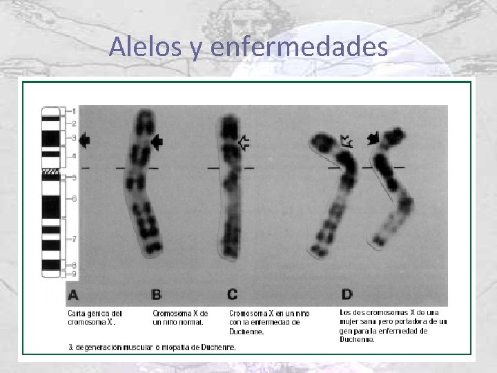 Alelos y enfermedades 