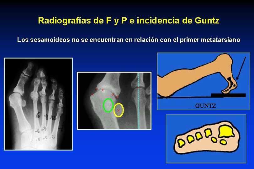 Radiografías de F y P e incidencia de Guntz Los sesamoideos no se encuentran